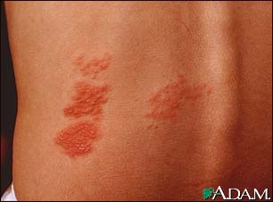 treatment for Shingles