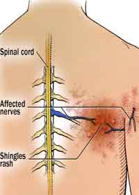 best Shingles treatments