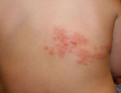 My Painful Shingles Rash At 56 Years Old